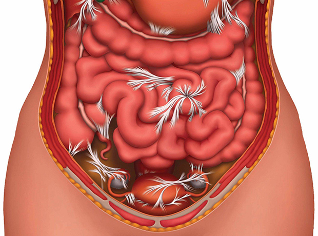 Спайки после операции: причины, способы лечения и профилактики