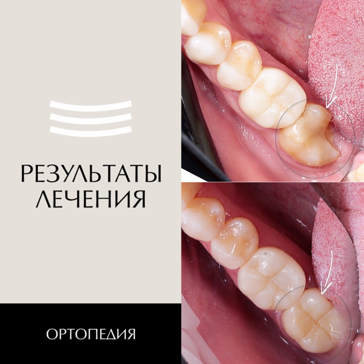 Результат лечения зуба после скола