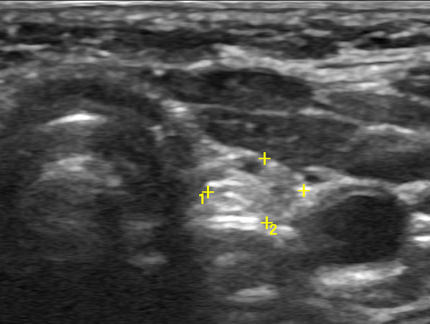 Канадское УЗИ щитовидной железы или 