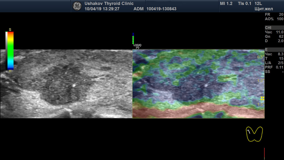 УЗИ узлов щитовидной железы. Эластография и контрастирование (2-й день VIII съезда специалистов УЗД)