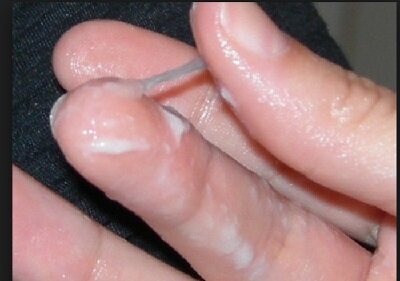 Частая причина обращения девушек за помощью к гинекологу-это молочница . Её симптомами могут быть : обильные или творожистые выделения из влагалища, которые доставляют дискомфорт при мочеиспускании, мацерации кожи и слизистых оболочек. А также зуд и жжение в области наружных половых органов, которые усиливаются во 2-ой половине дня, во время сна, после водных процедур, полового акта, длительной ходьбы, во время менструации. Встречаются и случаи когда заболевание может протекать бессимптомно. Молочница не передается половым путем. Иногда  кандидоз развивается на фоне какой-либо другой урогенитальной инфекции, которые как раз и передаются половым путем(например: хламидиоз, уреаплазмоз, трихоманиаз)- возбудители этих заболеваний провоцируют воспаление во влагалище, в результате , нарушается нормальный рН в эобласти влагалища, а так же соотношение нормальной и патогенной микрофлоры.). Многие женщины часто путешествуют, меняют режим  питания, зачастую  простужаются.В таких случаях нет гарантии,что  кандидоз вас больше никогда не побеспокоит- если вы пролечили молочницу, а она вернулась, это может быть не потому, что вам назначили неправильный курс. Это значит, что в вашей жизни есть некая причина, которая ее вновь спровоцировала...Если вы часто сталкиваетесь с молочницей, необходимо  исследовать микробиоту кишечника. Без лечения кандидоз может перейти в хроническую форму и периодически обостряться.