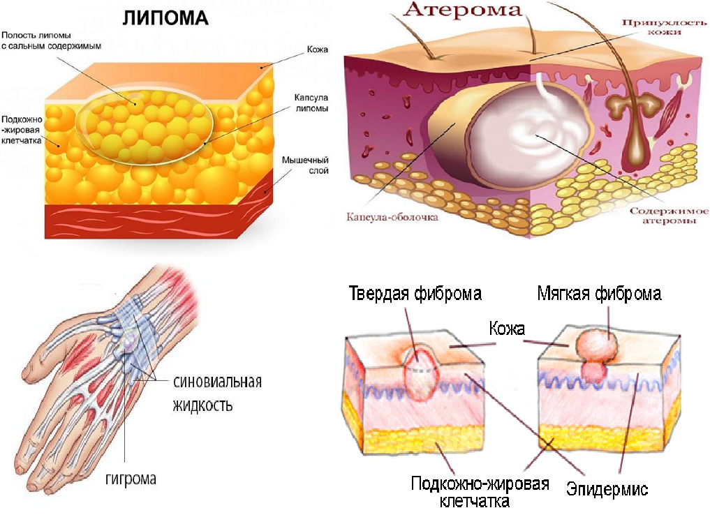 Липома (жировик)