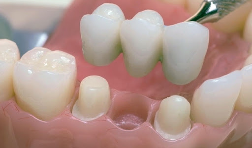 Опорные зубы под мостовидный протез обтачиваются на толщину покрывающих их коронок