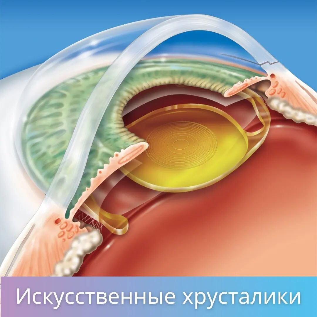  Замена хрусталика при катаракте. Как выбрать искусственный хрусталик?
Чем отличаются искусственные хрусталики и как сделать правильный выбор❓🤔
👁️‍🗨️ Разновидностей ИОЛ довольно много. Они отличаются по количеству фокусов, материалу, цвету, цене, фирме производителя.

При выборе хрусталика важно ответить для себя на следующие вопросы ⤵️

🔹На какое расстояние мне важнее всего видеть без очков❓
🔹Если выбирать между зрением вдаль или вблизи, что предпочтительнее для меня❓
🔹Готов/-а ли я использовать очки (для близи/дали) после операции или мне важно отказаться от них полностью❓

Ответы на эти вопросы помогут хирургу и вам сделать правильный выбор в пользу той или иной модели ИОЛ.

☑️ Монофокальные хрусталики — предназначены для обеспечения наилучшего зрения на одном расстоянии. Большинство людей, выбирающих монофокальные линзы в дальнейшем используют очки для чтения и для работы на близком расстоянии. Но и здесь все зависит от зрительных потребностей.
Кому-то важно именно вблизи обходиться без очков, а для дали использовать коррекцию.

☑️ Мультифокальные ИОЛ имеют несколько корректирующих зон, встроенных в линзу (подобно бифокальным или трифокальным очкам). Это позволяет видеть как ближние, так и далекие объекты. Также имеются мультифокальные хрусталики, корректирующие промежуточное зрение.

☑️ Торические линзы — для коррекции астигматизма.
