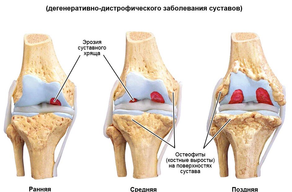 Степени развития гонартроза коленного сустава