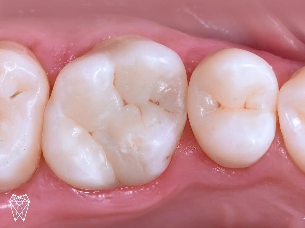 Случай из практики: пломба-терминатор | Стоматология Belgravia Dental ...
