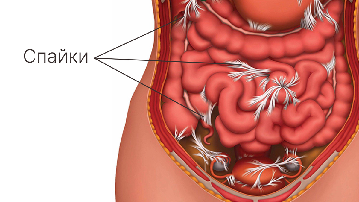 Спайки название. Кишечная непроходимость перитонит.