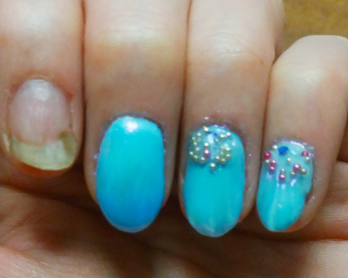 Онихолизис- отслойка ногтевой пластины 