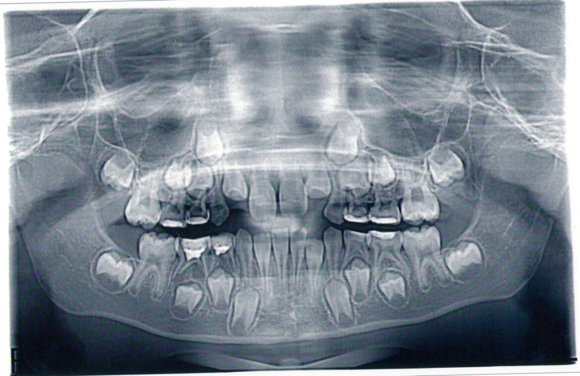 Зачаток молочного зуба. Ортопантомограмма (ОПТГ) (~0,013 м3 в). Ортопантомограмма челюсти. Сменный прикус 8-10 лет ОПТГ. Ортопантомограмма кариес.