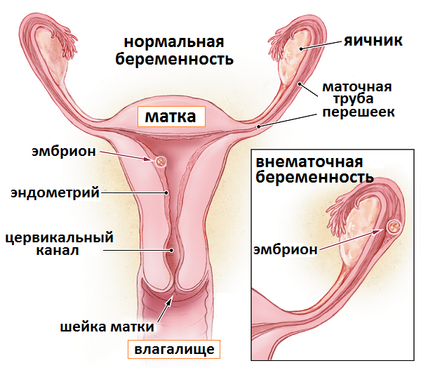 Коричневые выделения из влагалища