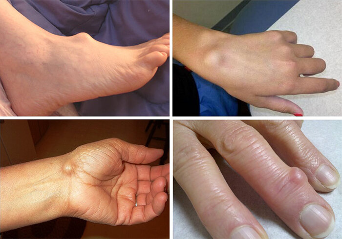 Чаще всего гигромы образуются рядом с суставом кисти рук или стопах