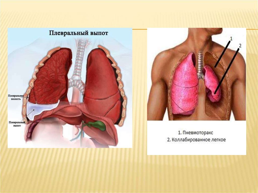 Сниженная функция легких. Частичный пневмоторакс. Плевральная полость пневмоторакс.
