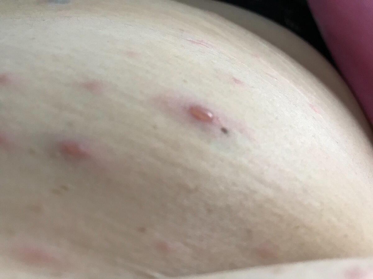 Водные пузыри по всему телу, после которых остаются шрамы