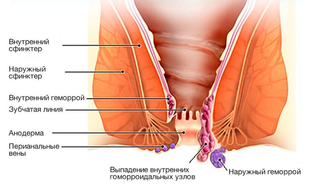 Нарост на анальном отверстии. Внутренние геморроидальные узлы. Папилломы в заднем проходе.