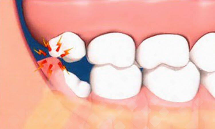 Ретинированный зуб – это опасно? | Стоматология Smile-at-Once | Дзен