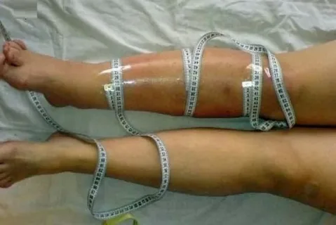 Отёки – это симптом широкого круга заболеваний