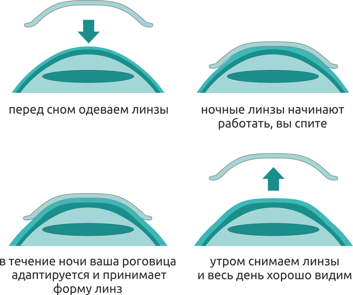 Можно ли носить линзы перед коррекцией. Ортокератологические линзы. Исправление зрения линзами. Линзы ночные для коррекции. Жесткие ночные линзы для коррекции зрения.