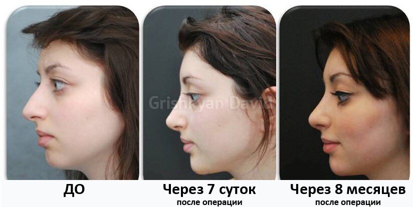 Как меняется нос после ринопластики по месяцам фото