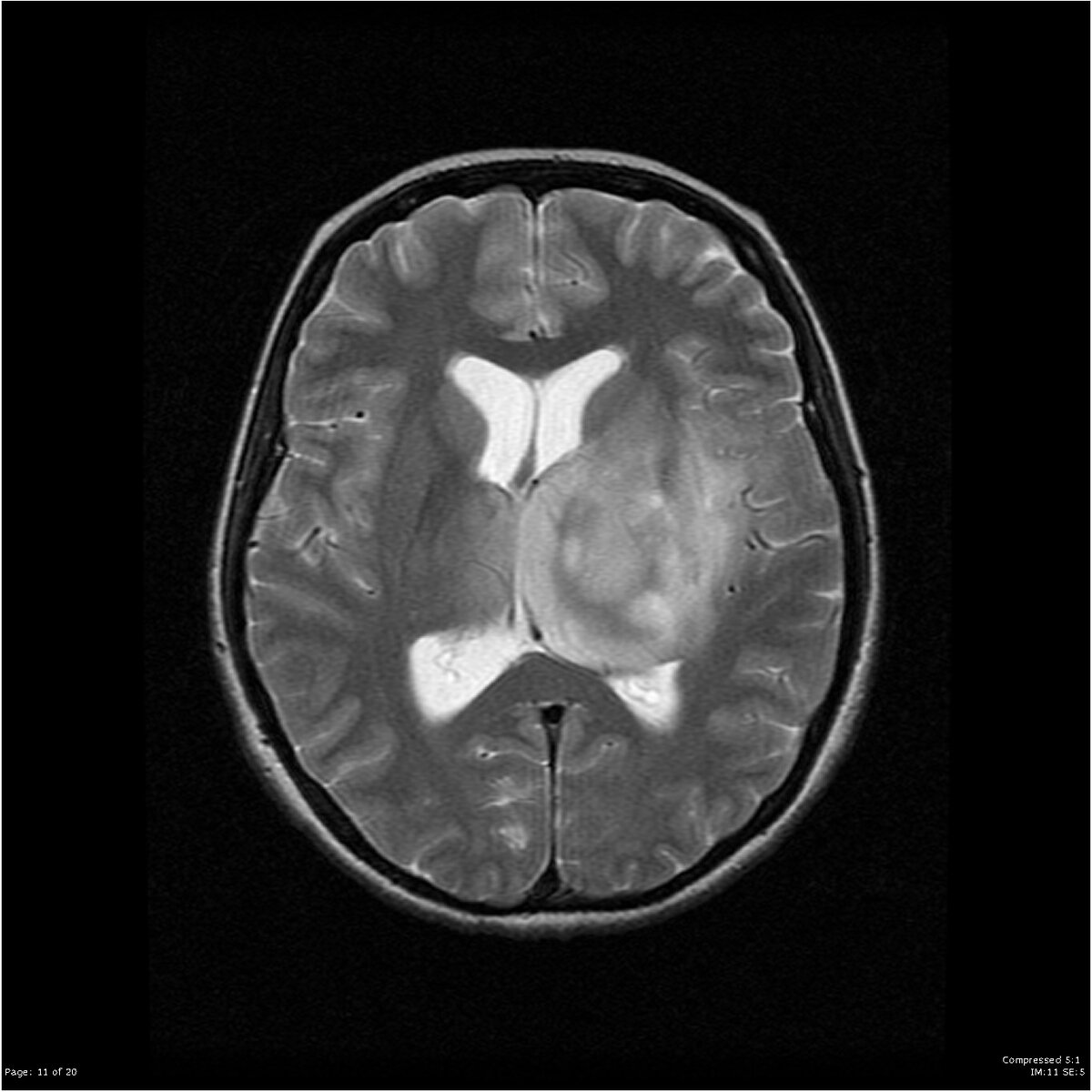 Вот так выглядит результат МРТ. Radiopedia.org
