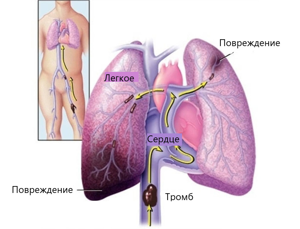 Нормальная артерия и атеросклероз. Легочный атеросклероз. Атеросклероз аорты на рентгенограмме. Ибс атеросклероз аорты. Легочный атеросклероз.