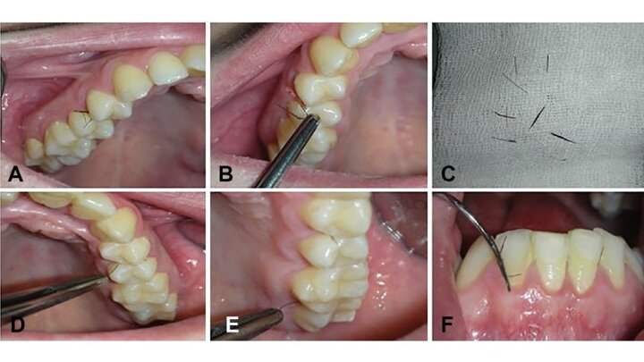 Появление волосков в полости рта - чрезвычайно редкое явление, его причины до сих пор точно неизвестны.Фото Zhurakivska, et al., Oral Surgery, Oral Medicine, Oral Pathology and Oral Radiology, 2020.