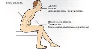 Типичная сердечная астма