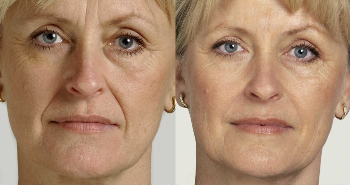 Носогубки. Источник фото яндекс картинки