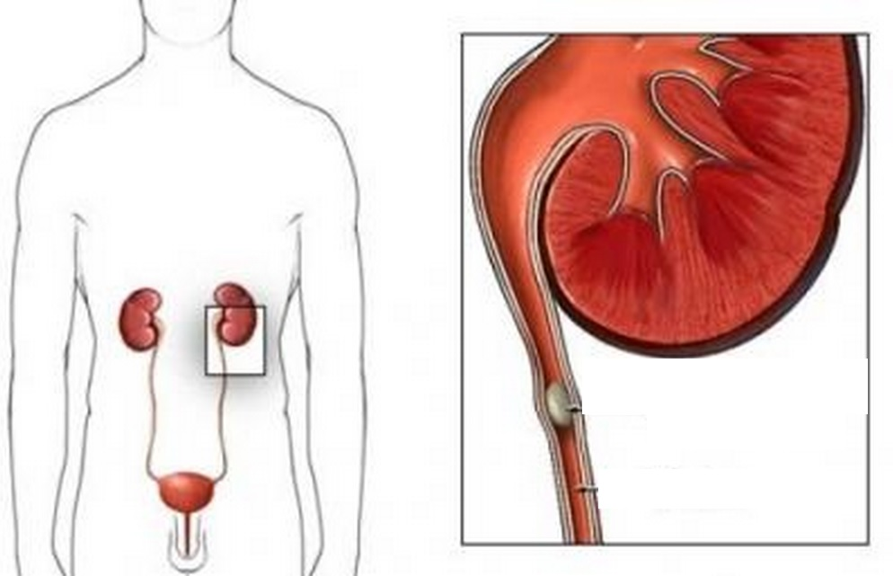 Обтурация мочеточника камнем.