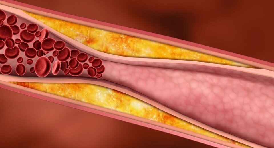 Бляшки в сосудах головы. Гиперхолестеринемия уровень холестерина. Холестериновые бляшки на ногах.