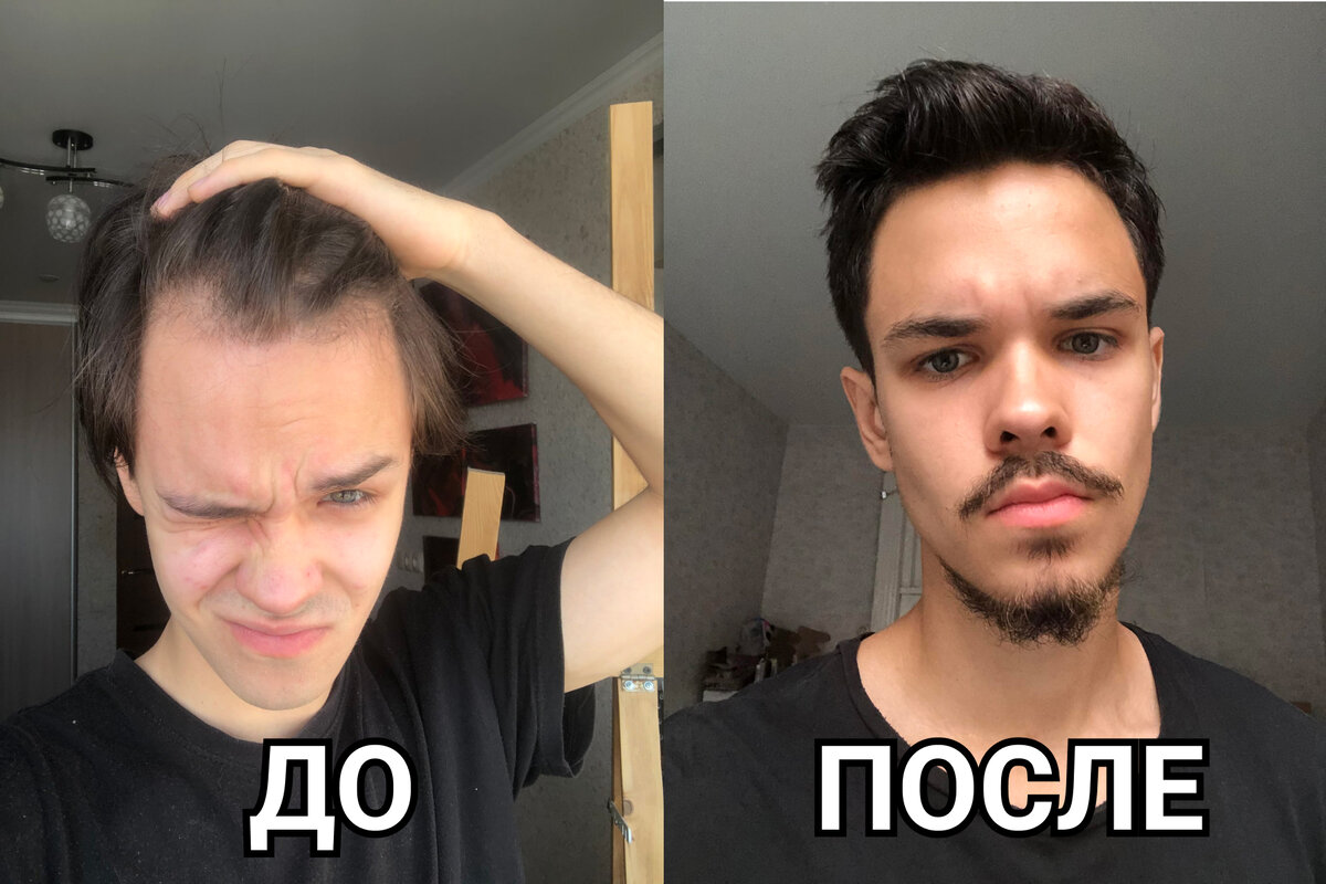 Вот так выглядел мой результат ДО и ПОСЛЕ. Разница между фото ~4 месяца