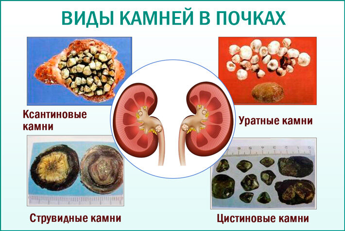 Клиническая картина мочекаменной болезни