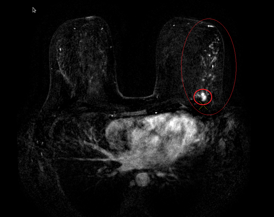 Мрт с контрастом москва. Мрт молочных желез. Мрт молочных желез с контрастом. : Мрт с контрастом: мрт молочных желез.