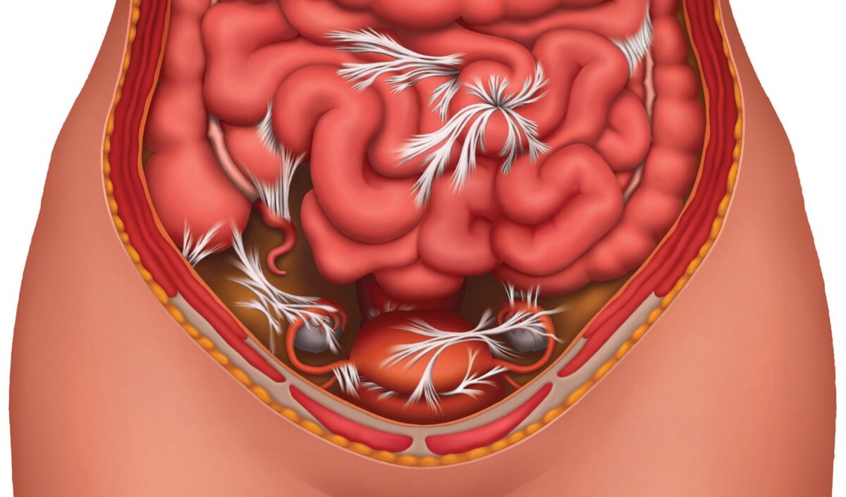 Спайки в брюшной полости – что это такое и чем опасно | НКЦ №2 (ЦКБ РАН) |  Дзен