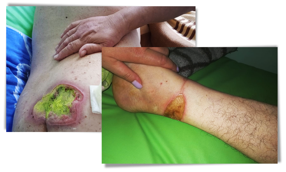 У пациента образовались пролежни и появились раны на запястьях. Фото: Алексей Зарайский/Octagon.Media