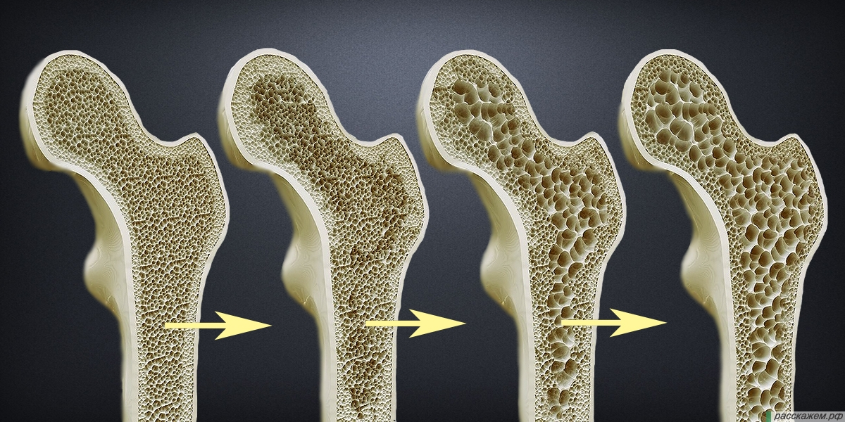 Вымывается кальций из костей