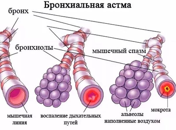 Возбудитель астмы. Бронхиальная астма. Изменение бронхов при бронхиальной астме. Бронхи при астме.