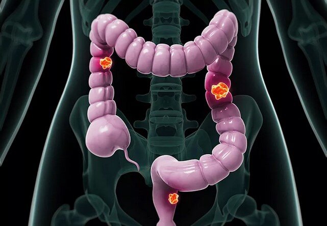 Как распознать рак кишечника? | Между нами | Дзен