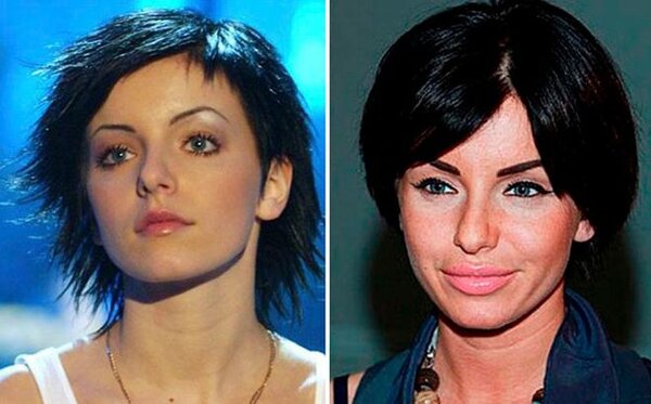 Российские женщины знаменитости, которые увеличили губы и стали выглядеть по-другому