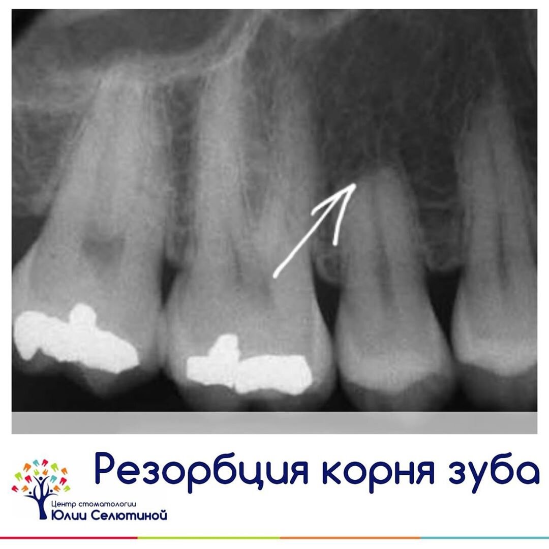 Апикальная резорбция корня