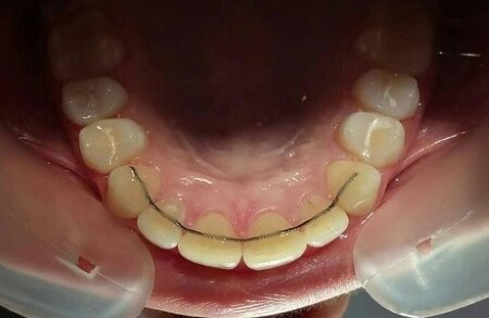 Так крепится несъемный ретейнер