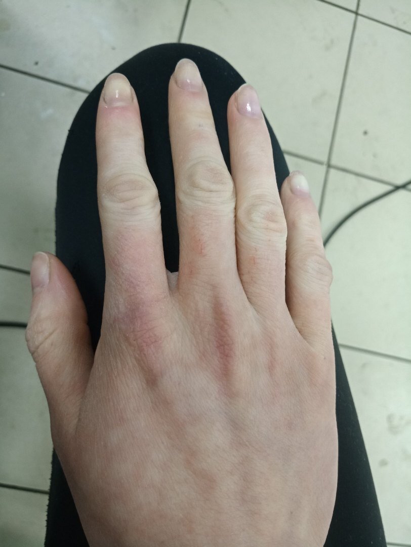 Испорченные ногти