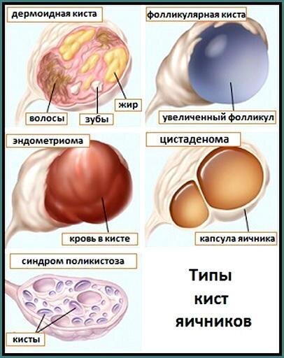 Лечение кисты яичника