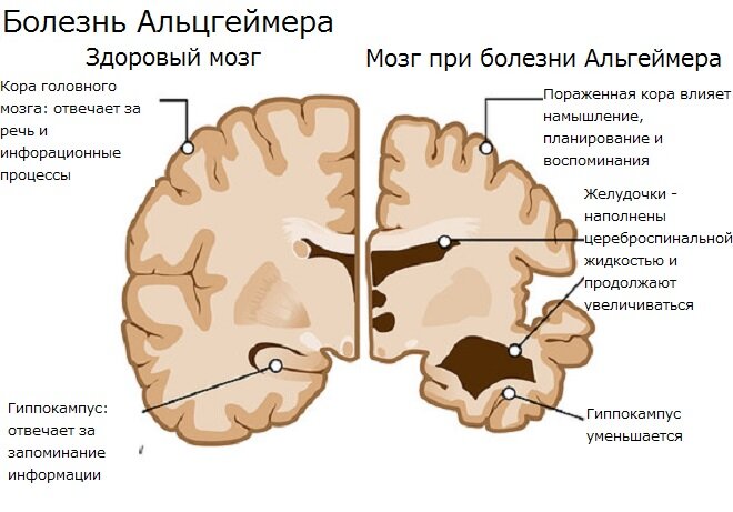 [caption id="attachment_1071" align="aligncenter" width="655"] Больной и здоровый мозг - сравнение[/caption]