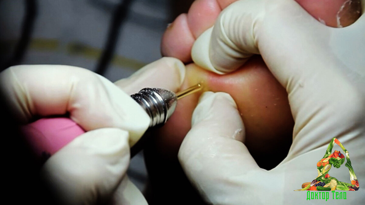 Специальные процедуры в салоне. Лазерное удаление. Электрокоагуляция.