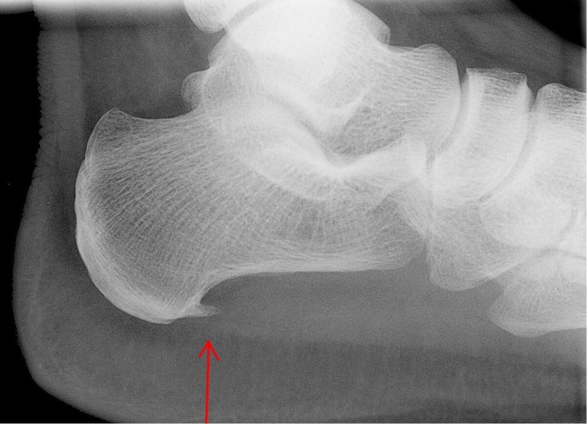 Пяточная зона. Хаглунда Шинца рентген. Болезнь Хаглунда-Шинца. Пяточная шпора рентген. Экзостоз пяточной кости.