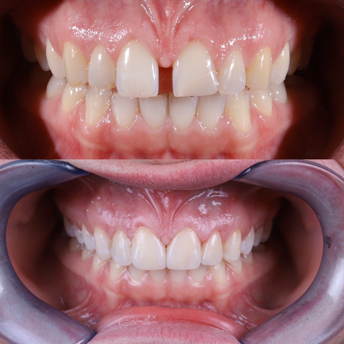 В клинику Русс-Дент обратился пациент с жалобой на эстетическую проблему, а именно, промежуток между двух центральных резцов (диастема). Помимо эстетической проблемы в ходе осмотра были выявлены и функциональные, а именно:стертые клыки и резцы в результате чего не происходило размыкания жевательной группы зубов при акте жевания, Что привело бы в последующем к проблемам со стороны ВНЧС , болям Мышц в области лица и шеи , а также стёртым жевательным зубам.   Пациент за помощью обратился вовремя. Болей со стороны мышц и внчс при диагностике выявлено не было. 
В первое посещение были сняты слепки с верхней и нежней челюсти для изготовления гипсовых моделей и их анализа. 
В технической лаборатории было выполнено восковое моделирование фронтальной группы зубов. (Закрытие диастемы, восстановление стертых поверхностей зубов)
На втором приёме пациенту из пластмассы перевели макет будущей улыбки. Улыбка пациента сразу преобразилась. В это же посещение было проведено препарирование зубов( в пределах эмали 0,3-0,5 мм), снятие слепков для изготовление виниров(360)на рефракторе(чистая керамика, максимально естественна). Далее изготовлены временные виниры. 
Через 1 неделю работа была готова, сначала произведена примерка готовых конструкций, пациент одобрил новую форму зубов и далее приступили к фиксации готовых реставраций из керамики.


 
