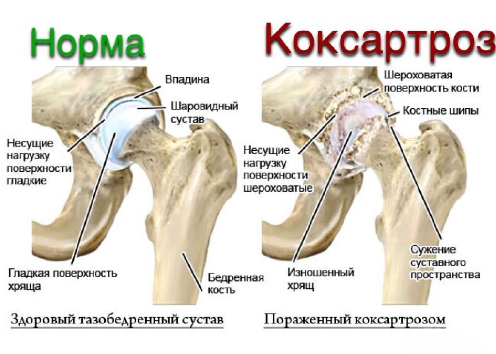 Причины возникновения и диагностирование болей в тазобедренном суставе