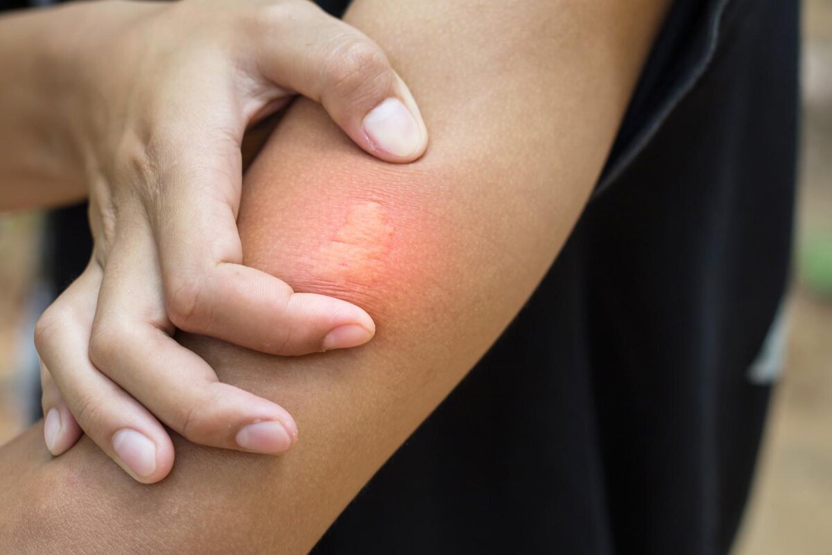 Shutterstock📷Диаметр зудящего пятна в норме варьируется от 1 до 5 см