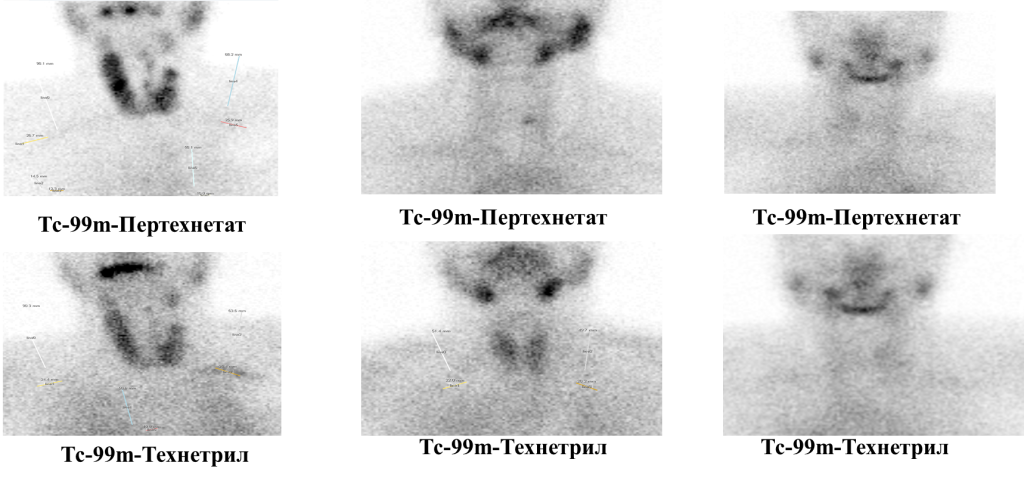 Холодный узел щитовидной железы сцинтиграфия. Сцинтиграфия щитовидной новосибирск. Сцинтиграфия щитовидной новосибирск. Сцинтиграфия щитовидной новосибирск. Цинтиграфиящитовидной железы.