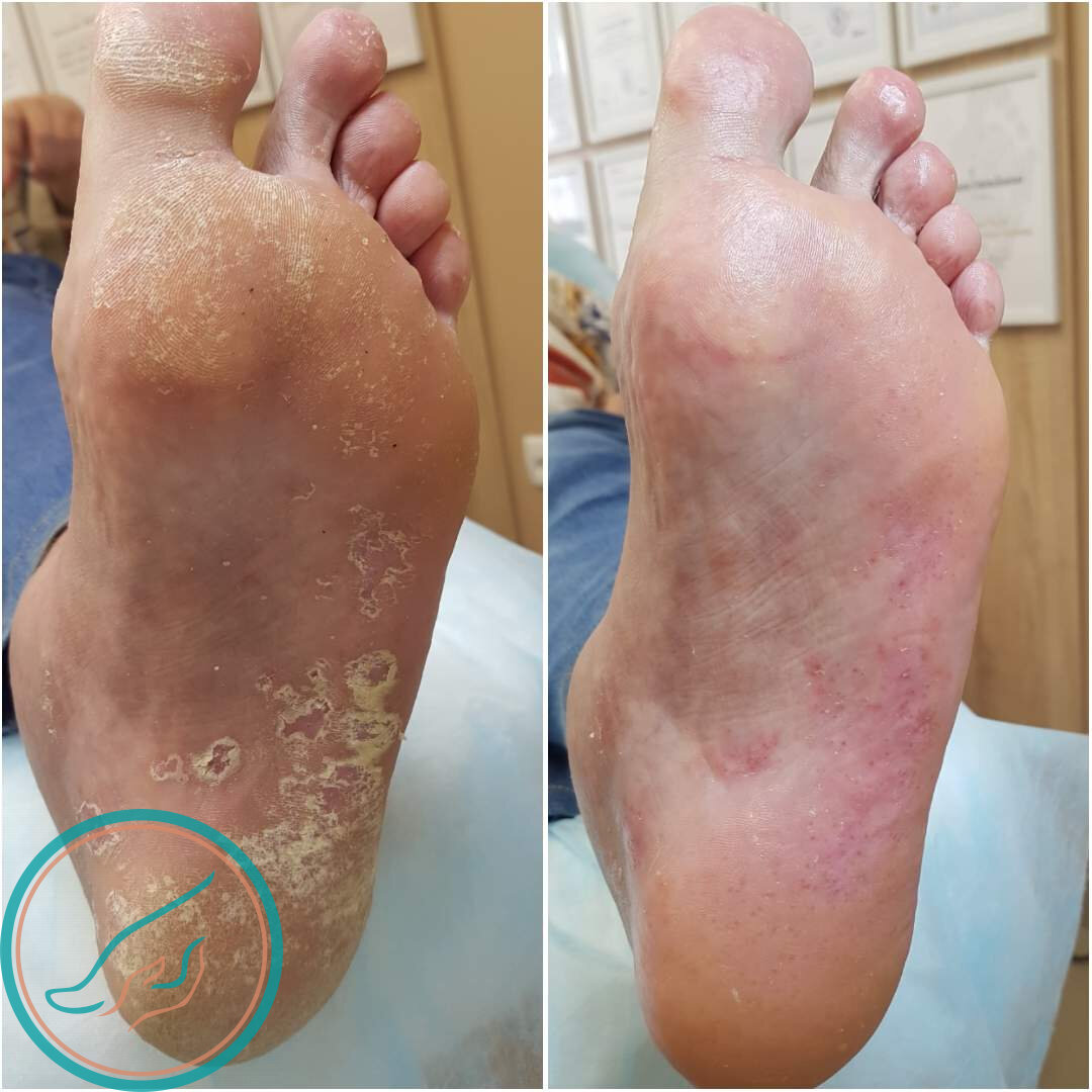 Микоз стопы, до и после обработки в Центре подологии.